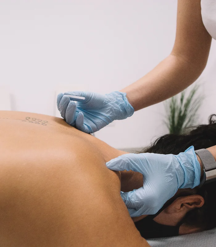 Dry Needling ankeny ia